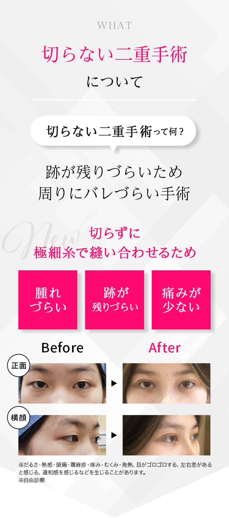 切らない二重手術について
